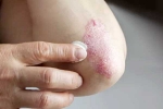 Skin disorders health issues, Skin disorders news, five common skin disorders and their symptoms, Acne