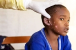 Monkeypox Outbreak India, Monkeypox Outbreak new, is monkeypox outbreak coming to india, Monkeypox