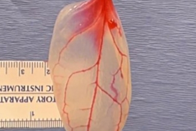 Patch For Diseased Hearts Using Spinach Leaves?