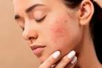 home remedies, skin, 10 ways to get rid of pimples at home, Home remedies