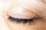 Eyelash Dandruff treatment, Eyelash Dandruff health, all about eyelash dandruff, Dry skin